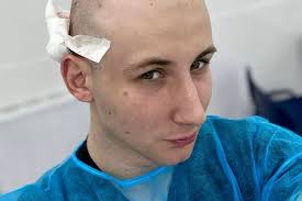 Man who was going bald spends £5k hair transplant