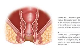 Image result for Rectal Prolapse