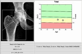 bone density testing