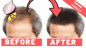 Afterwards, rub it on any bald patch on your scalp. Onion Juice For Hair Growth Does It Work 2019 Youtube