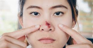 Nasenherpes Ursache Behandlung Von Herpes In Der Nase