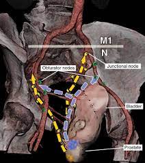 Was working in a metal workshop carrying around steel plates all day. Pathways Of Lymphatic Spread In Male Urogenital Pelvic Malignancies Radiographics