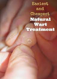 Most Effective Homemade Remedies For Removing Warts Health Food And Drink Natural Wart Remedies Wart Treatment Warts Remedy