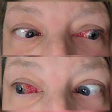 When will the vision settle after cataract surgery with intraocular lens  implants?