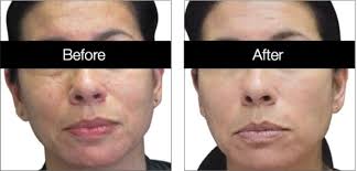 Skin Resurfacing Treatments