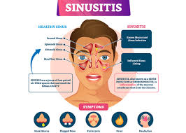 Image result for Rhinitis
