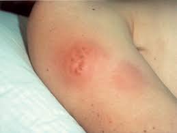 Image result for Panniculitis