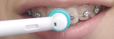The Best Toothbrush For Braces Electric Manual 2021
