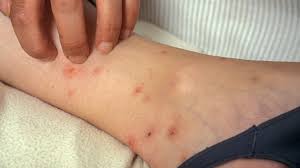 Image result for Cimex lectularius bites
