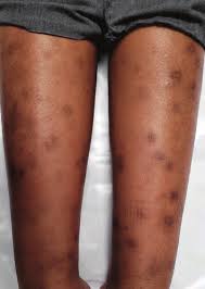 Image result for Papular urticaria