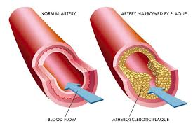 Image result for Hypertriglyceridemia