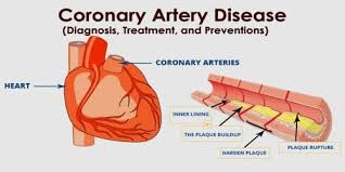Coronary Artery Disease Diagnosis Treatment And Preventions Assignment Point