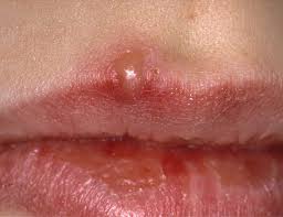 Whenever i bite the inside of my mouth, there's a very good chance that it develops into a mouth ulcer. Cold Sores Vs Canker Sores Vs Chancres