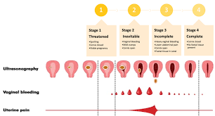 Image result for Recurrent Miscarriage