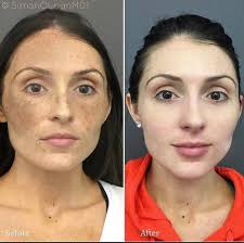 Image result for Melasma