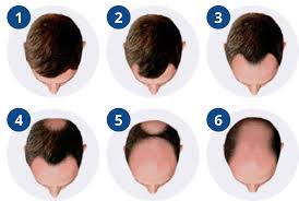 Deze behandeling is ontwikkeld in samenwerking met onze artsen. Behulpzame Gids Bij Haaruitval Alopecia Androgenetica