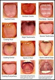 71 veritable tcm tongue diagnosis chart