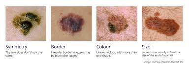 خبز محمص ملزمة استيقظ صور لأنواع سرطان الجلد guillotinpoilvet com