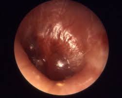 Outer ear infections can be classified depending on how long they last and how much of your ear if earwax or loose material is blocking your ear canal, it can stop ear drops from working properly. 5 Days Of Antibiotics Won T Cut It For Middle Ear Infections