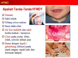 Ruam umumnya muncul pada telapak tangan dan kaki, dan juga dapat muncul pada bokong dan/atau kelamin. Penyakit Kaki Tangan Dan Mulut Hfmd Tadika Zon Pintar ÙÙŠØ³Ø¨ÙˆÙƒ