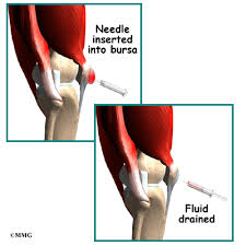Alternatively, use a decongestant or. Prepatellar Bursitis Eorthopod Com