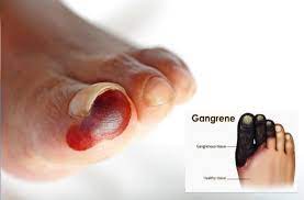 He was the cosmonaut who was selected from over three thousand fighter pilots. Gangrene Causes Symptoms And Treatment à¤š à¤Ÿ à¤²à¤—à¤¨ à¤ªà¤° à¤œ à¤¯ à¤¦ à¤Ÿ à¤‡à¤Ÿ à¤¨ à¤¬ à¤§ à¤ªà¤Ÿ à¤Ÿ à¤¹ à¤¸à¤•à¤¤ à¤¹ à¤— à¤—à¤° à¤¨ Patrika News