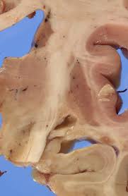 Image result for Pallidotomy