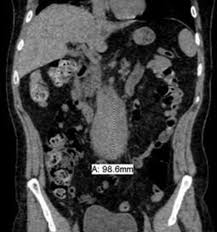Concomitant Presentation Of Igg4 Negative Idiopathic Retroperitoneal Fibrosis And Addison S Disease Bmj Case Reports