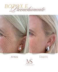 ✨ Antes & Depois que falam por si ✨ Resultados naturais, olhar mais leve e  pele revitalizada 💉💆‍♀️ Você também merece viver essa experiência: ver  seu rosto sem rugas de expressão, com
