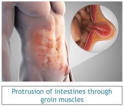 Image result for Inguinal hernia man