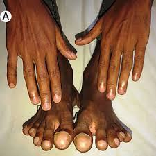 Image result for Clubbing nails feet