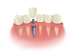 A dental implant for one tooth costs anywhere between $3000 and $4500 in bergen county. How Much Do Dental Implants Cost Medbye Com