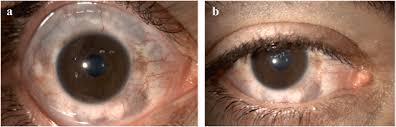 Image result for melanosis sclera