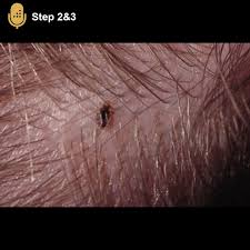 Image result for pubic lice symptoms