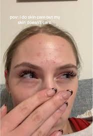 Being Vulnerable About Acne and Skincare