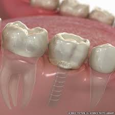 I'm not the best at this, so bare with me! Dentists Warn Of Risks Of Not Looking After Implants Bbc News