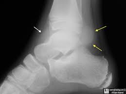 Image result for Ankle XRay
