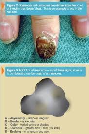 These spots are called &quot;actinic lentigines,&quot; Skin Cancer Treatment For Hand And Upper Extremity New York Brooklyn