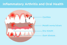 If you have an older dog and have never checked their gums before, this might be a little tricky as the what to look for. Inflammatory Arthritis And Oral Health Prevention Symptoms Treatment