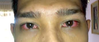 Karena jika kita tidak bisa melihat jelas apa yang ada didepan, maka kita rasa sakit pada mata biasanya terasa pegal terlebih untuk melihat kanan dan ke kiri. Sakit Mata Akuadi Org