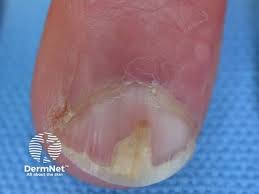 Image result for Akutní zánět nehtového lůžka