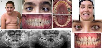 Nance-Horan Syndrome: characterization of dental, clinical and molecular  features in three new families