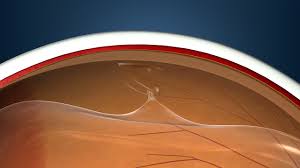 A torn retina is when you have a hole or tear in your retina. Retinal Tear Cincinnati Retinal Tear Treatment Northern Kentucky