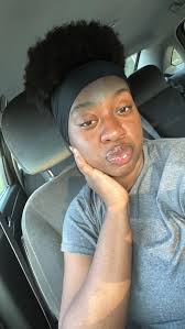 How to clear up acne?