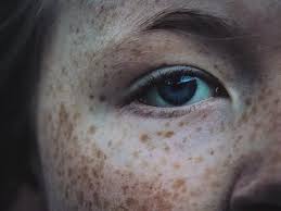 Image result for Freckled skin