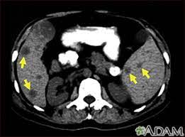 If your symptoms or other findings suggest that the cancer could be more advanced, however, you may need to have ct scans of the head, chest, and/or abdomen. Abdominal Ct Scan Information Mount Sinai New York