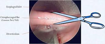 Maybe you would like to learn more about one of these? Zenker S Diverticulum What Is Zenker S Diverticulum Zenker S Diverticulum Symptoms Treatment Diagnosis Ucla