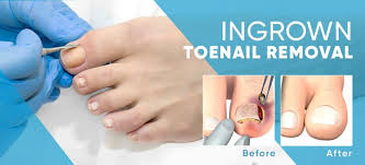 Image result for Toenail Removal