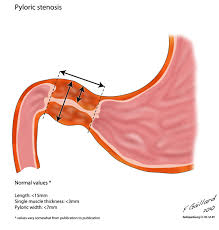 Hypertrophic Pyloric Stenosis Classically Presents As Non Bilious Projectile Vomiting During The Second Month Of Lif Stenosis Radiology Ultrasound Sonography