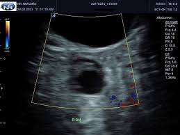 Image result for corpus luteum sonography)